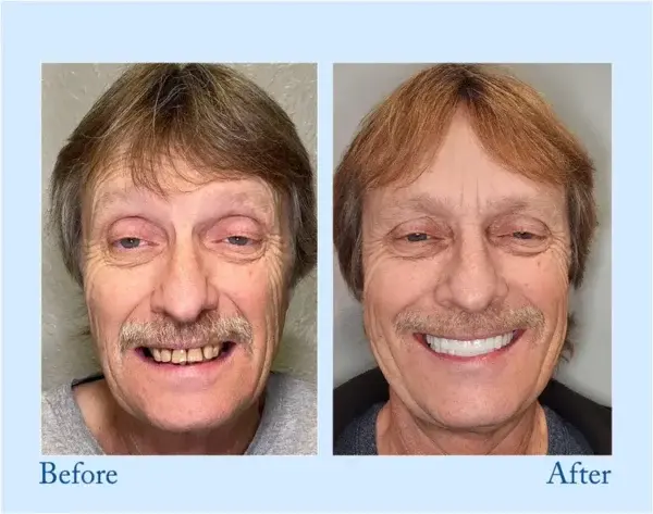 Advanced Customized Full Denture Set - Image 7