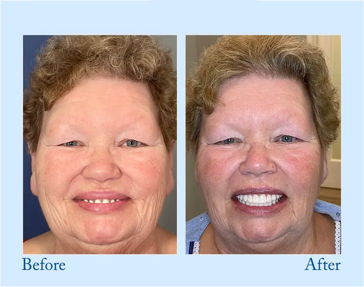 🦷Advanced Customized Full Denture Set🦷 - Image 9