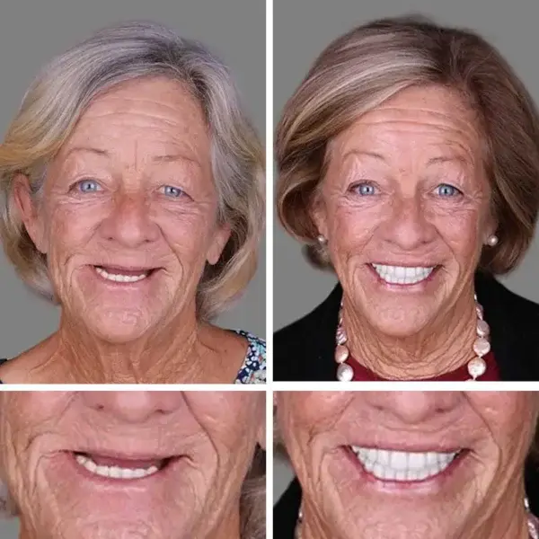 Affordable –Advanced Customized Full Denture Set🦷 - Image 12