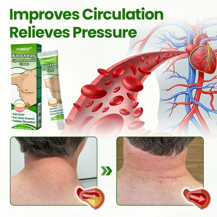 Lipoma Removal Cream - Image 6