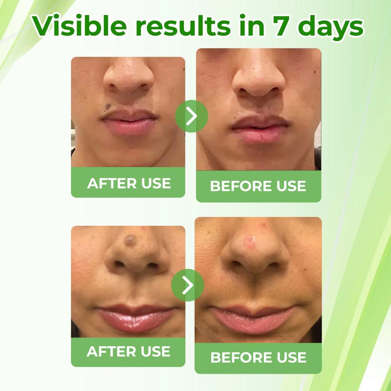 Natural Spot and Mole Removal Cream - Image 6