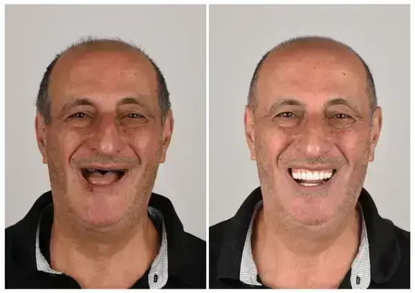 🦷 Custom-Fit Functional Dentures 😁 Smile with Confidence - Image 2