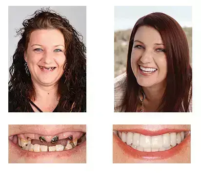 🦷 Custom-Fit Functional Dentures 😁 Smile with Confidence - Image 5