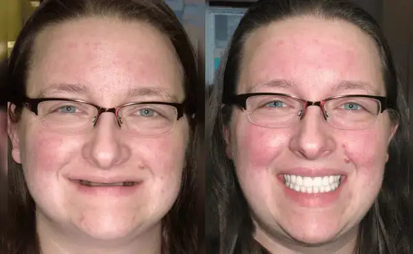 🦷Advanced Customized Full Denture Set🦷 - Image 6