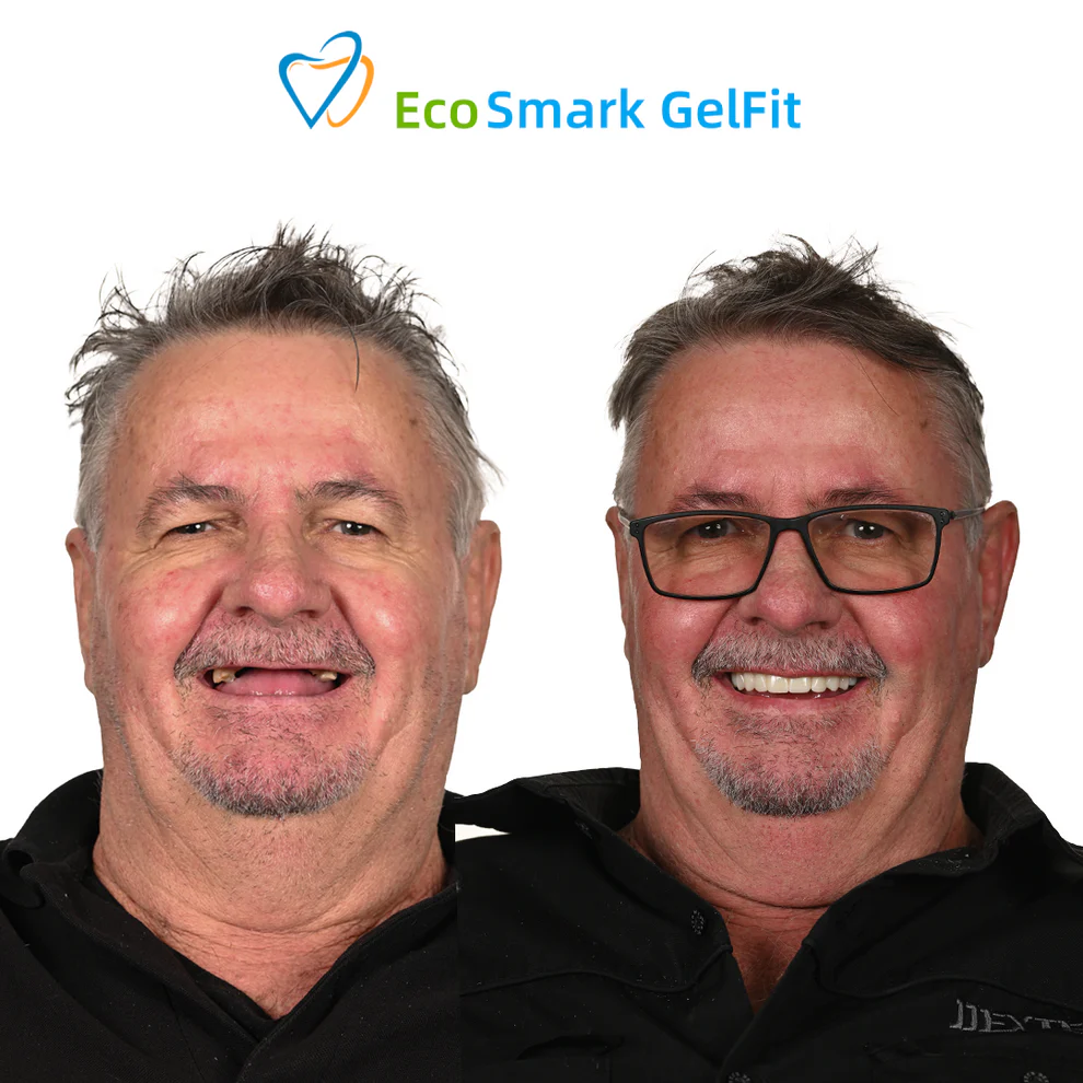 GelFit Dentures - Image 6