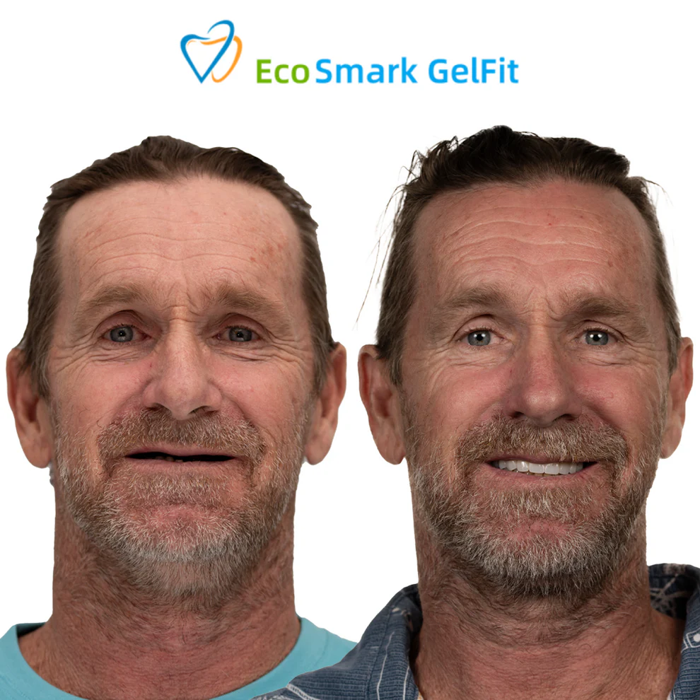 GelFit Dentures - Image 8