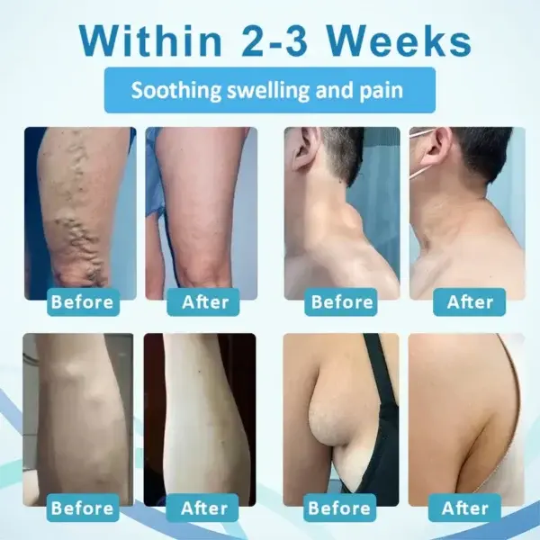 Support Roll-On - Image 4