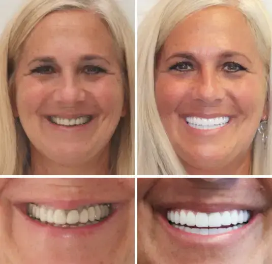 🦷Advanced Customized Full Denture Set🦷 - Image 7