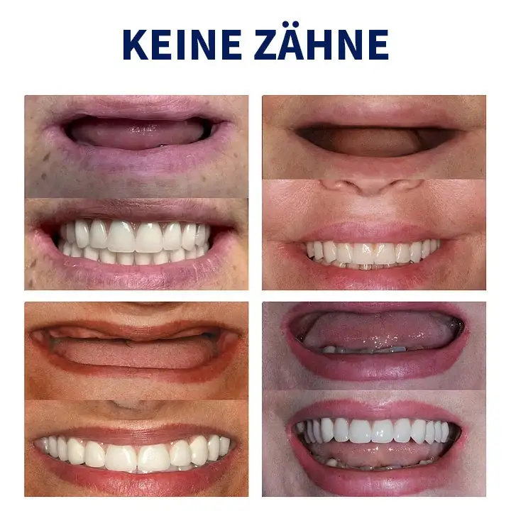 🦷 Fortgeschrittenes, maßgeschneidertes Vollprothesen-Set 🦷 (⏰ Limitierter Rabatt, nur noch 30 Minuten verfügbar ⏰) - Image 7