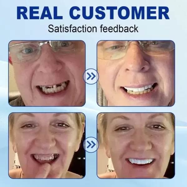 Advanced Customized Full Denture Set - Image 10