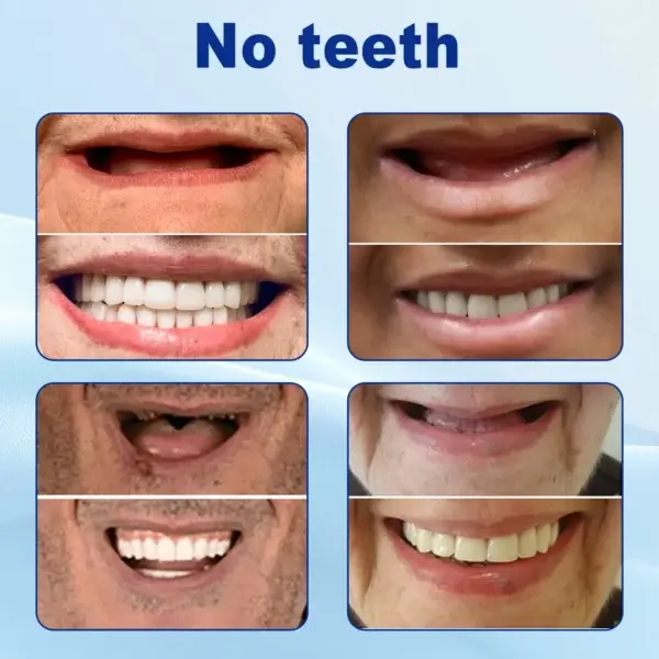 Advanced Customized Full Denture Set - Image 6