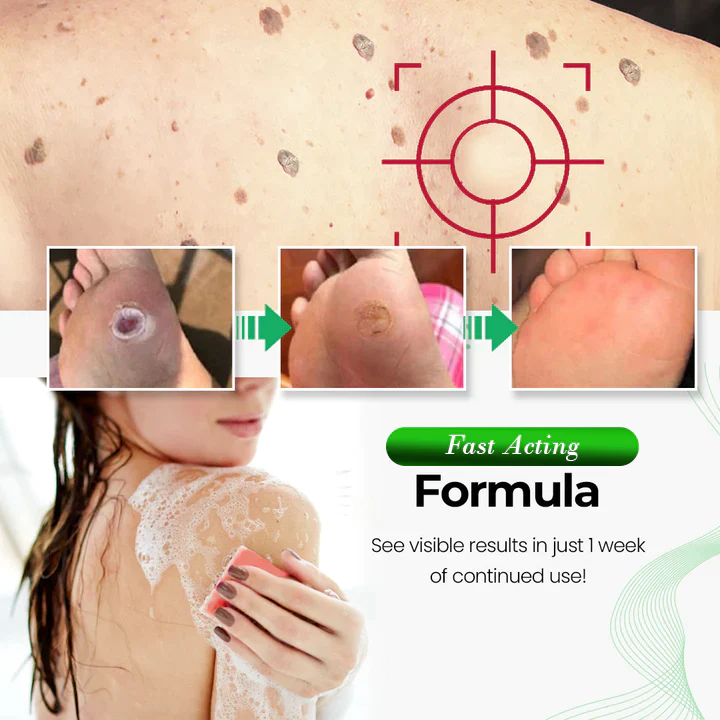 Wart Wipeout Soap - Image 5