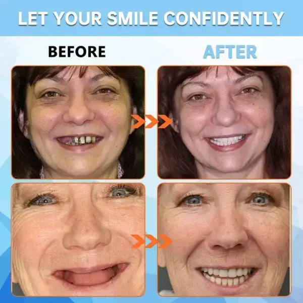 Adhesive teeth (upper and lower) - Image 8