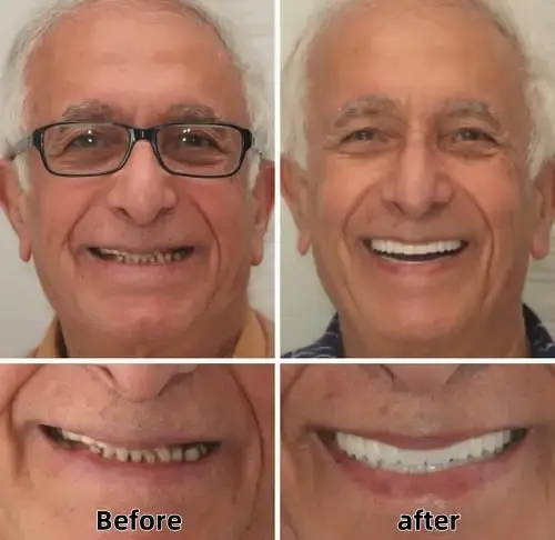 Advanced Custom-Fit Functional Dentures - Image 5