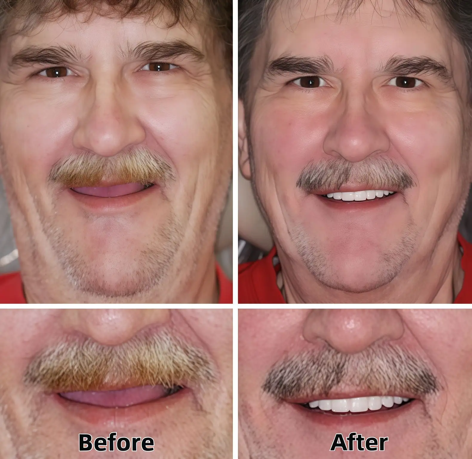Advanced Custom-Fit Functional Dentures - Image 5