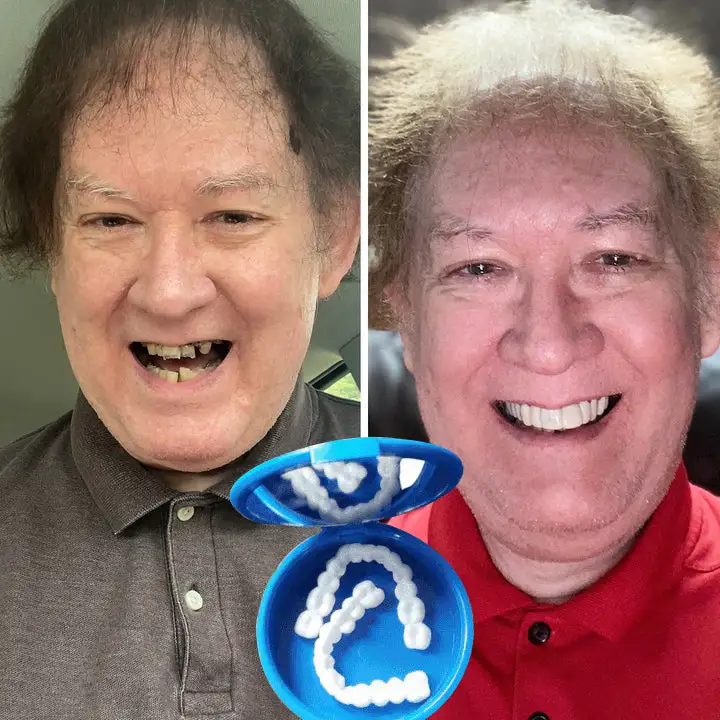 Affordable Denture Solution to Restore Your Natural Smile at Home - Image 2