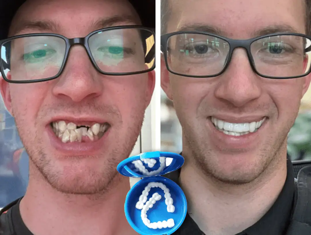 Affordable Denture Solution to Restore Your Natural Smile at Home - Image 3