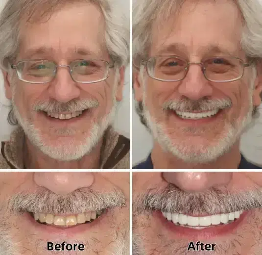 Advanced Custom-Fit Functional Dentures - Image 6