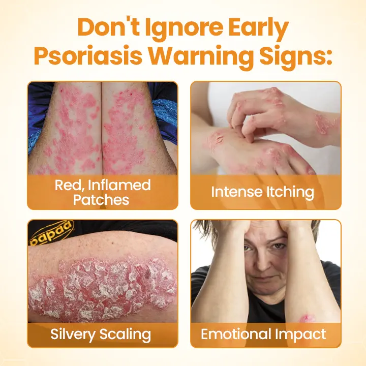 BeeLieves Psoriasis Repair Ointment - Image 5