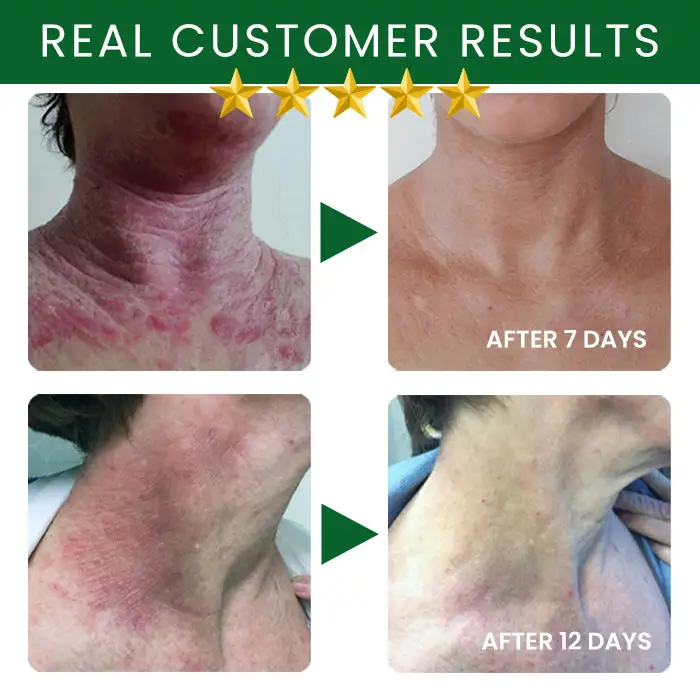 Tea Tree Oil Skin Treatment Cream - Image 7