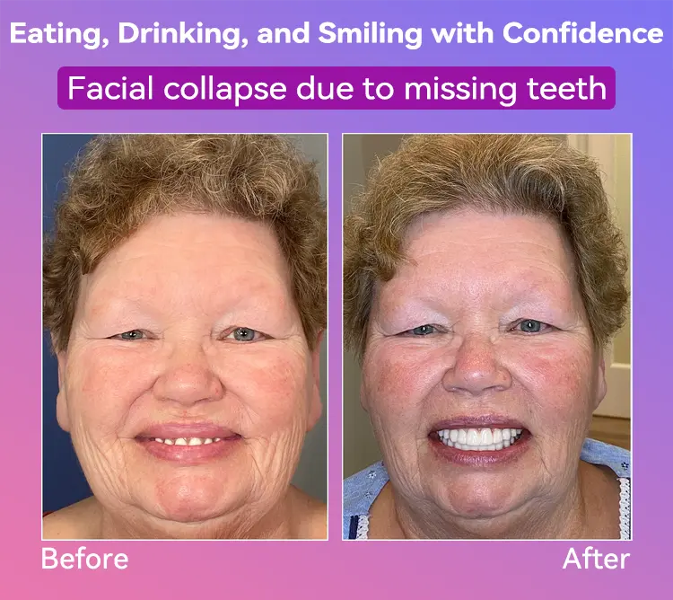 Latest Premium Comfort Dentures - Image 5