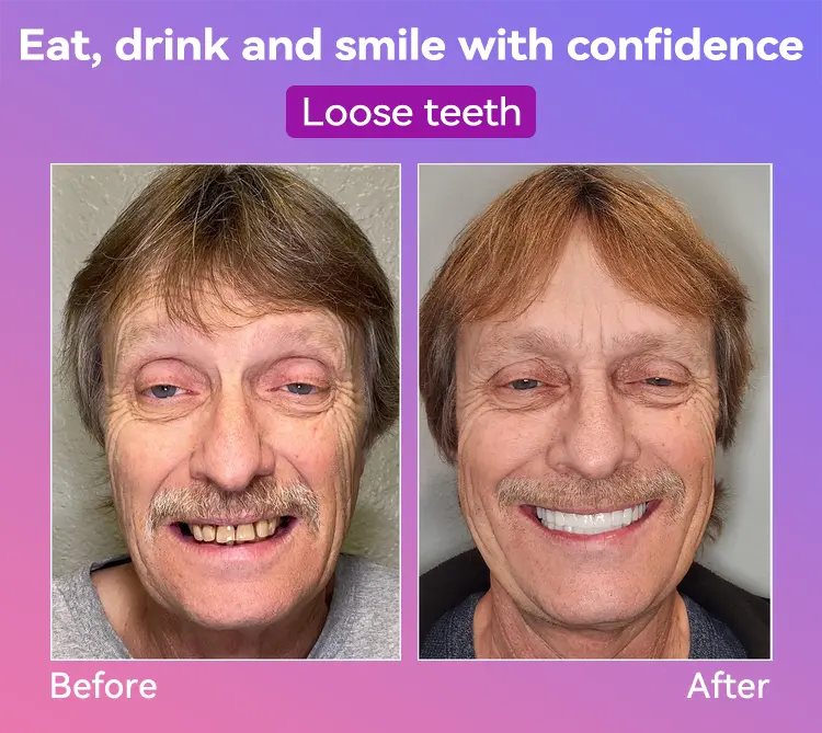 Latest Premium Comfort Dentures - Image 3