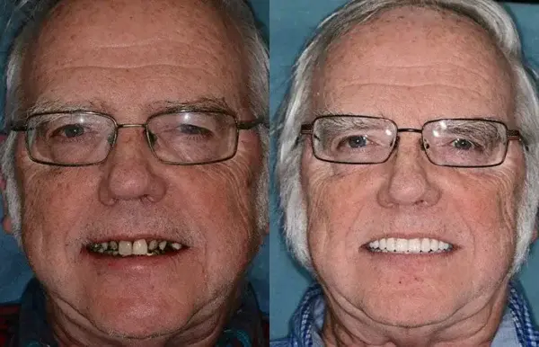 Advanced Customized Full Denture Set - Image 11