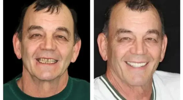 Advanced Customized Full Denture Set - Image 13