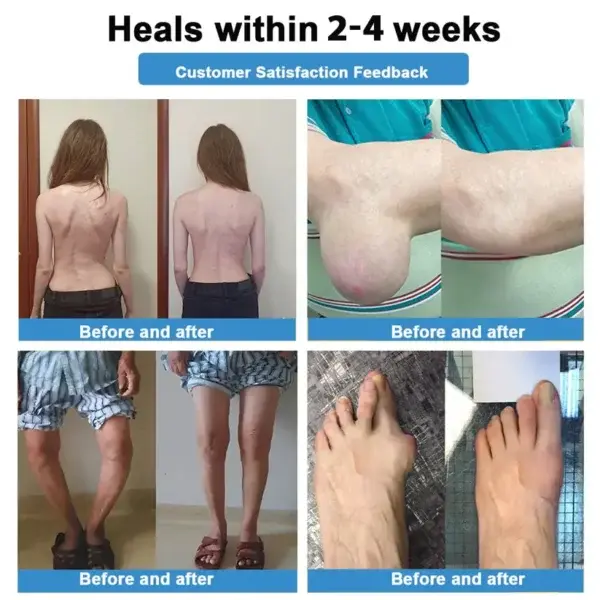 Nano-Microneedle Joint Patch - Image 4