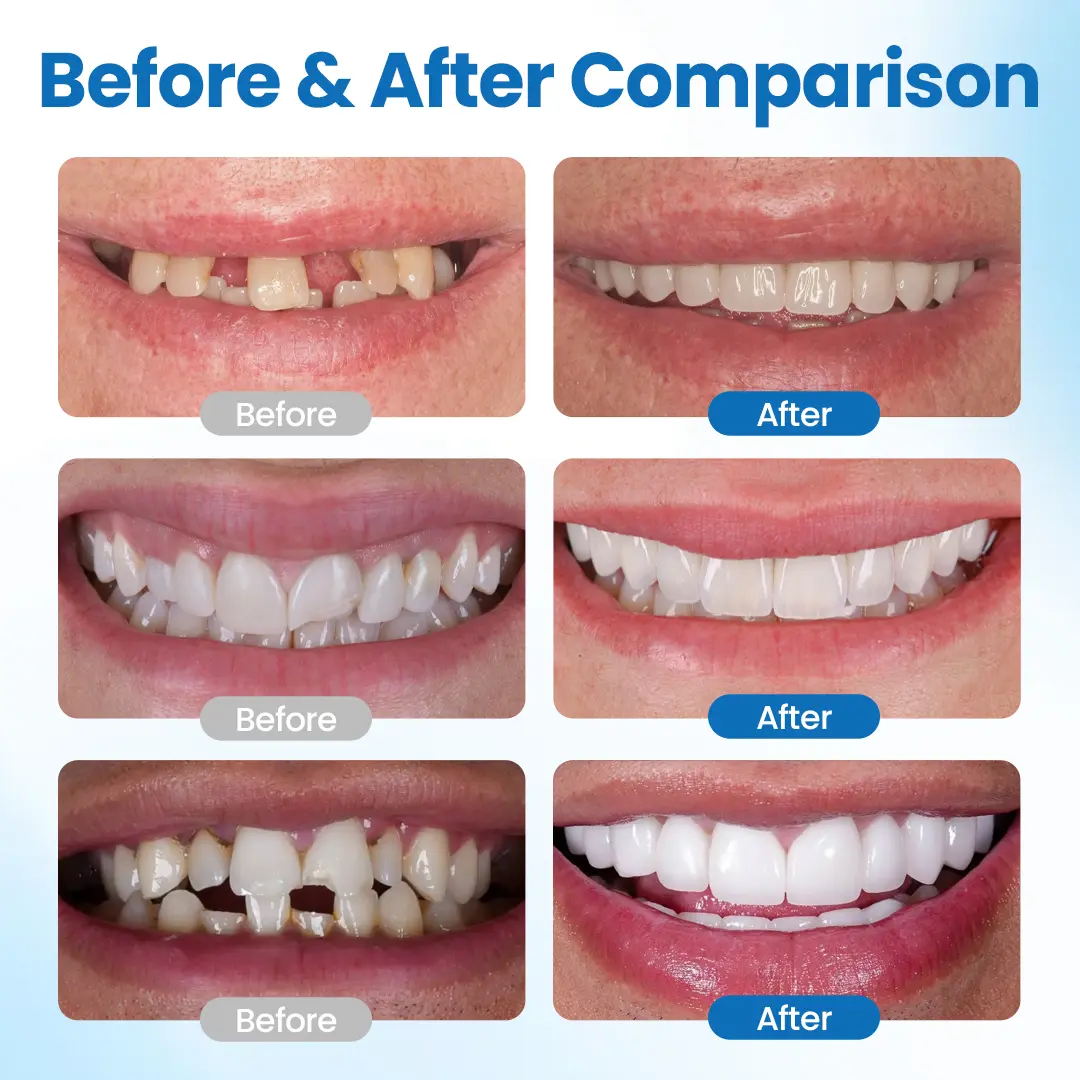 Tooth Repair Filling Kit - Image 6