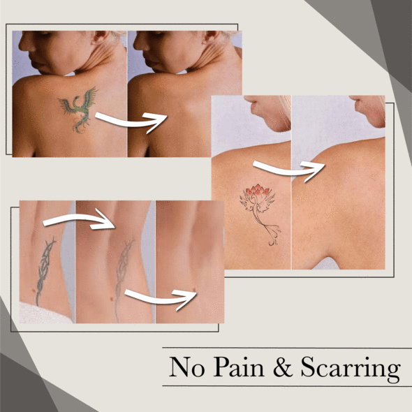 Natural Fading Tattoo Removal Cream - Image 6