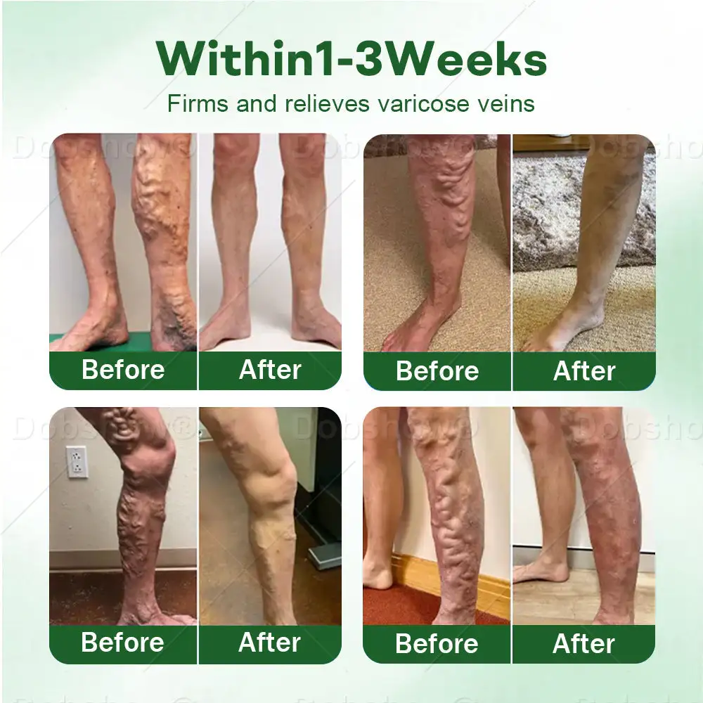 VeinLock Microneedle Patch - Image 5