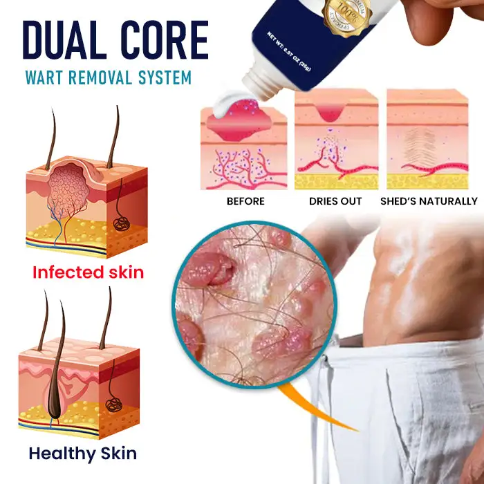 Genital Warts Remover Cream - Image 6