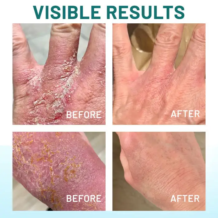 Probiotic + B 24-7 Moisture Eczema Relief Cream - Image 4