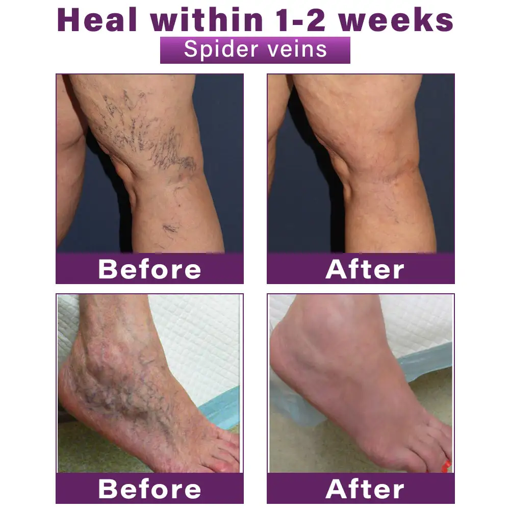 Polidocanol Nano Varicose Vein Relief Patch - Image 3