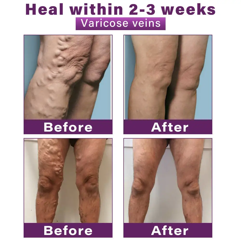 Polidocanol Nano Varicose Vein Relief Patch - Image 4