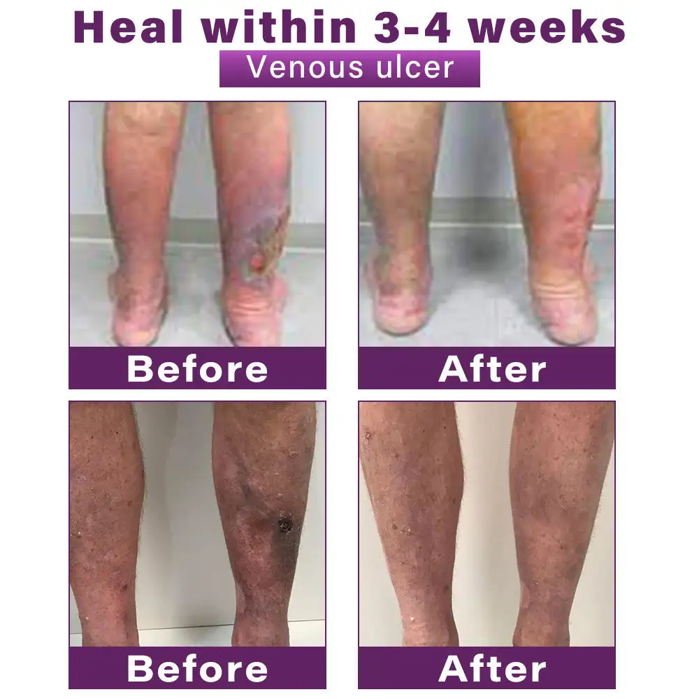 Polidocanol Nano Varicose Vein Relief Patch - Image 5