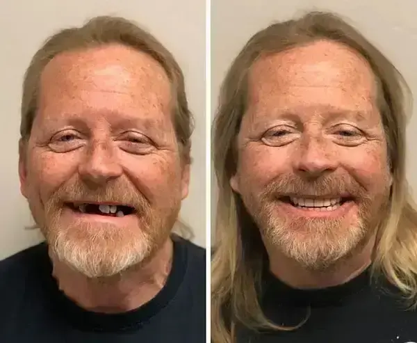 SmileFitPro BioFusion Dentures - Image 10