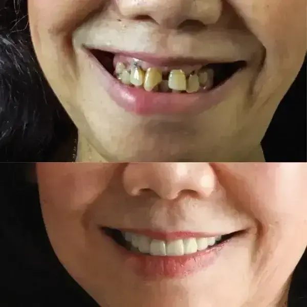 SmileFitPro BioFusion Dentures - Image 11