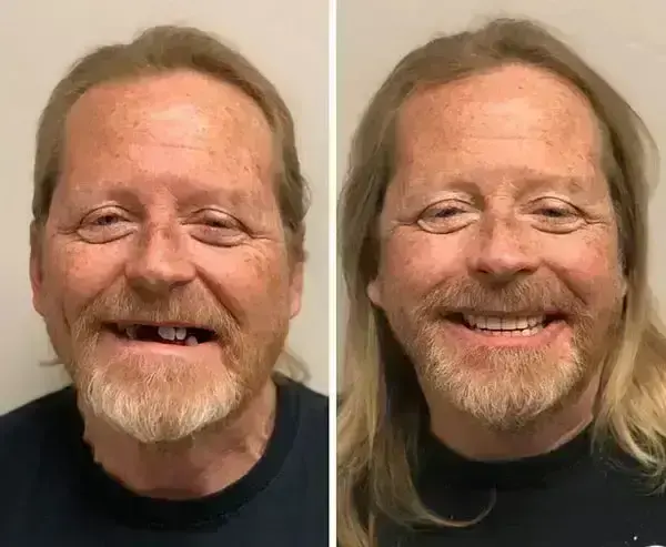 SmileFitPro BioFusion Dentures - Image 10