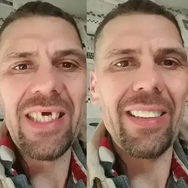 SmileFitPro BioFusion Dentures - Image 7