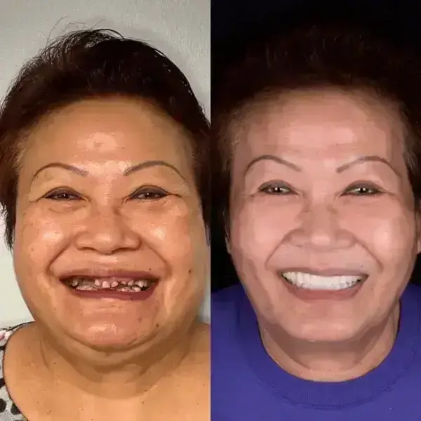 SmileFitPro BioFusion Dentures - Image 8