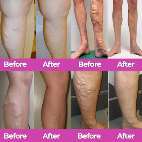 VeinFlow Advanced Varicose Vein Patch - Image 9