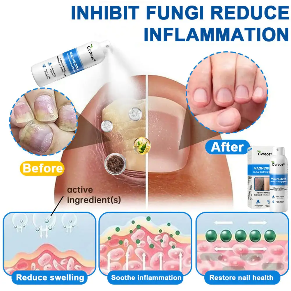 Magnesium Herbal Psoriasis Spray - Image 5