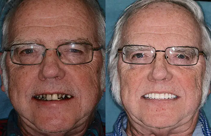 --🦷Advanced Customized Full Denture Set🦷 {Developed by Harvard University} - Image 9