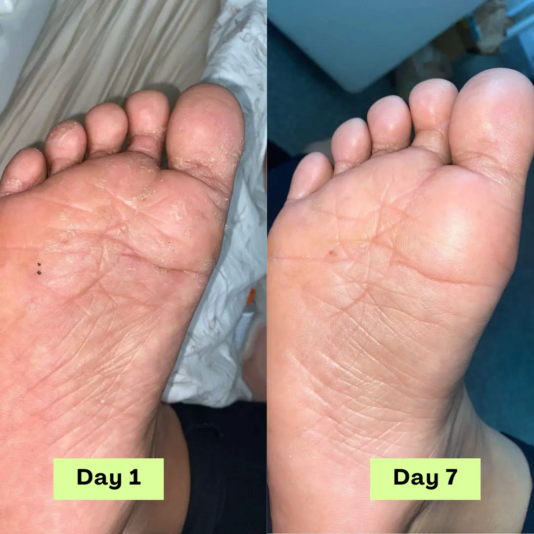 AntiFungal Relief Soap Bar - Image 4