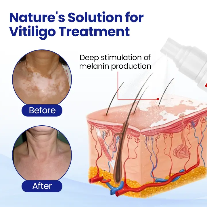 Vitiligo Treatment Spray - Image 5