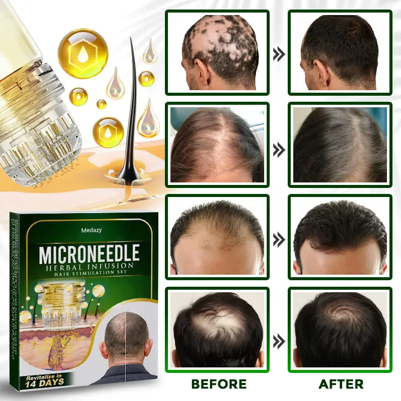 Microneedle Herbal Infusion Hair Stimulation Set - Image 4