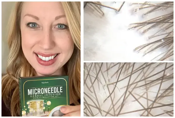 Microneedle Herbal Infusion Hair Stimulation Set - Image 7