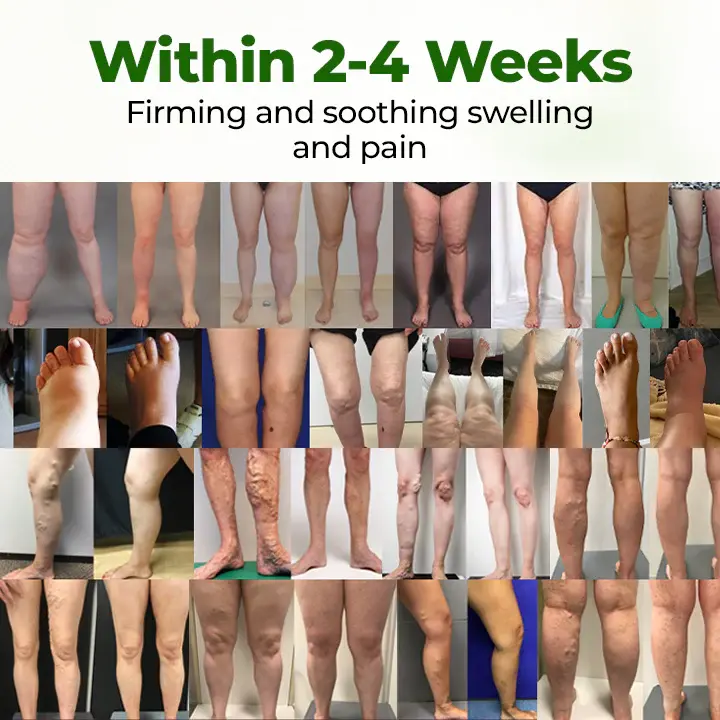 FluidEase Leg Therapy Edema Cream - Image 5